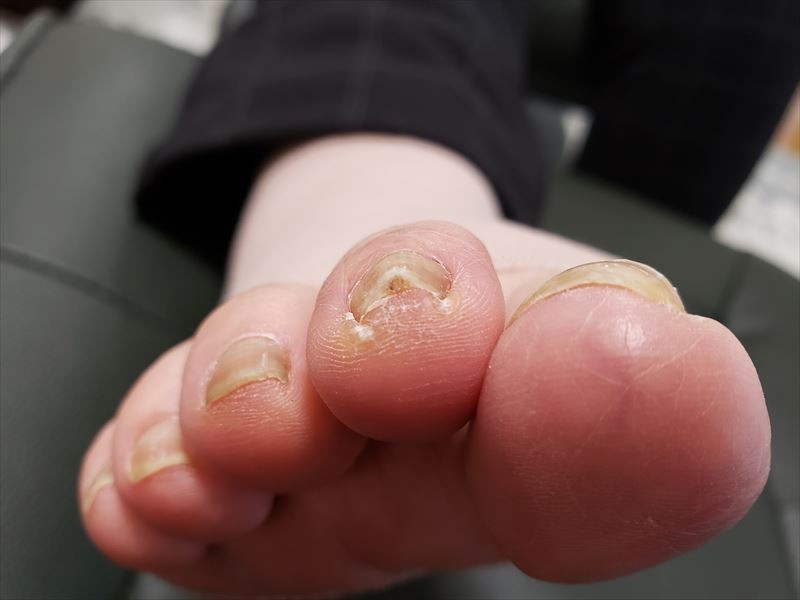 【奈良】巻き爪は足の親指以外もなります